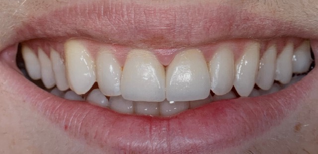 Front Teeth Veneers